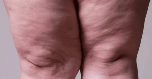 Suplementos para Lipedema: Quais Funcionam